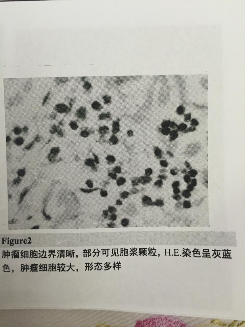 肥大细胞瘤