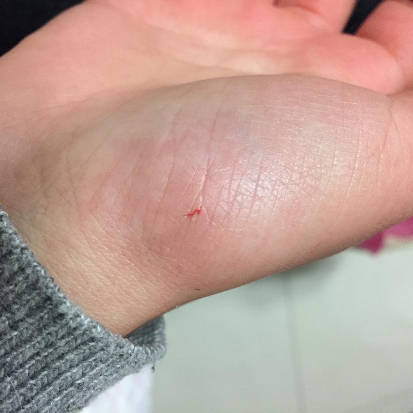 猫抓伤出血
